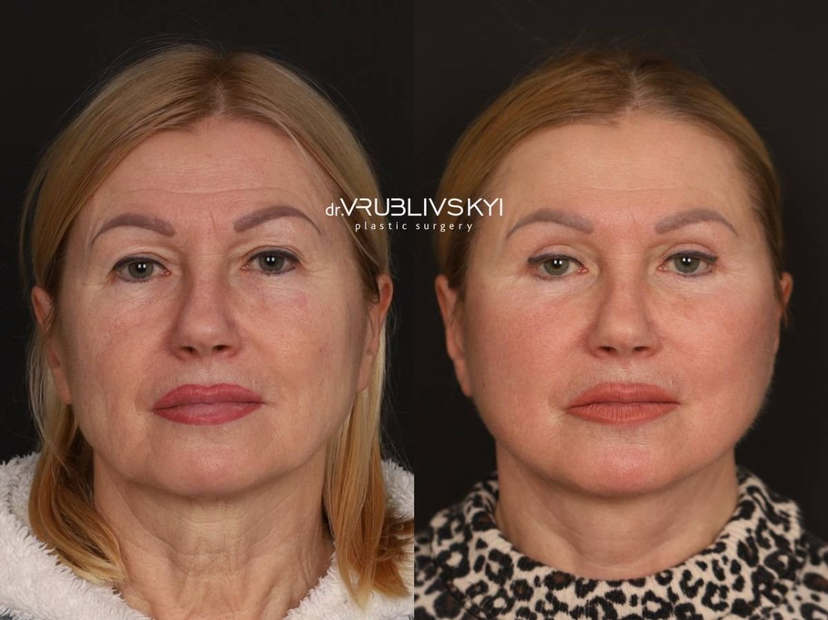 Facelift before and after results at Dr. VRUBLIVSKYI Plastic Surgery, facial rejuvenation