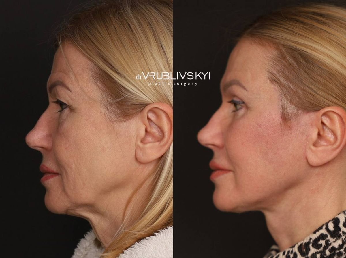 نتائج شد الوجه قبل وبعد في Dr. VRUBLIVSKYI Plastic Surgery، تجديد شباب الوجه