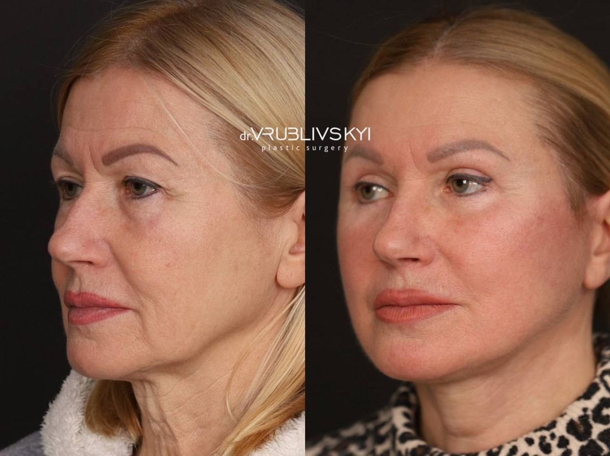 Facelift before and after results at Dr. VRUBLIVSKYI Plastic Surgery, visible facial rejuvenation