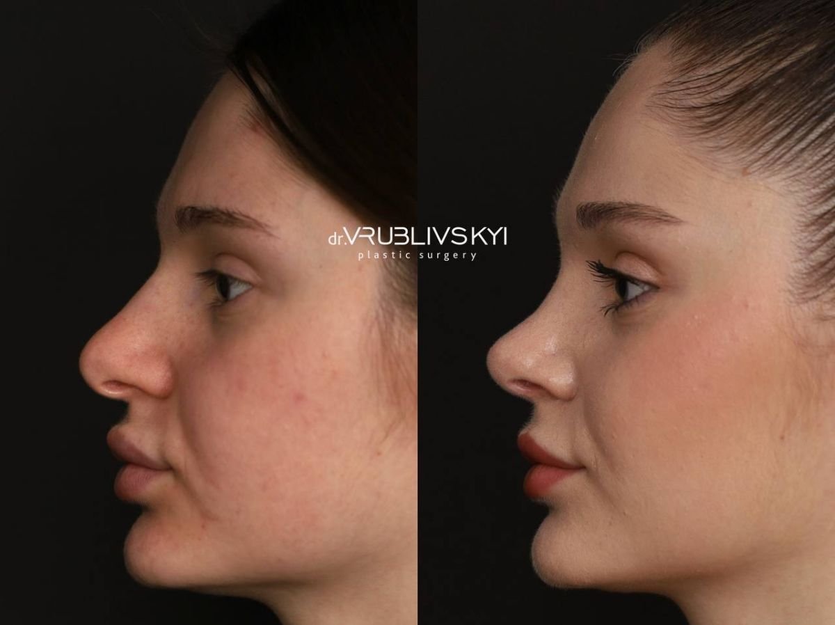 Résultats avant et après rhinoplastie chez Dr. VRUBLIVSKYI Plastic Surgery, profil du nez amélioré