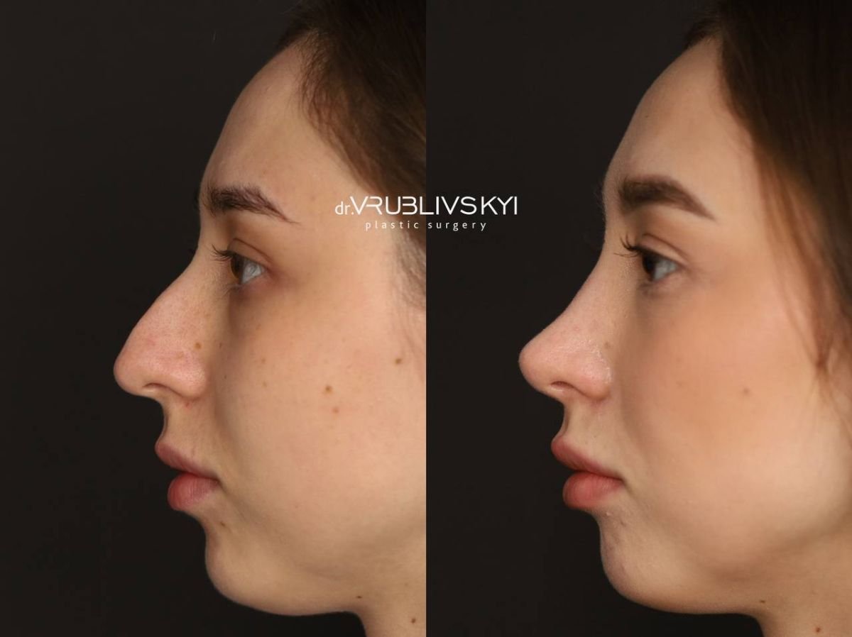 Before and after rhinoplasty results at Dr. VRUBLIVSKYI Plastic Surgery, nose reshaping