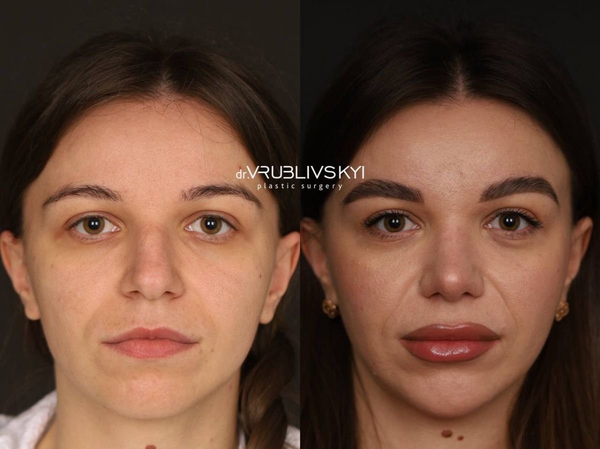 Resultados de rinoplastia antes y después en Dr. VRUBLIVSKYI Plastic Surgery, remodelación nasal