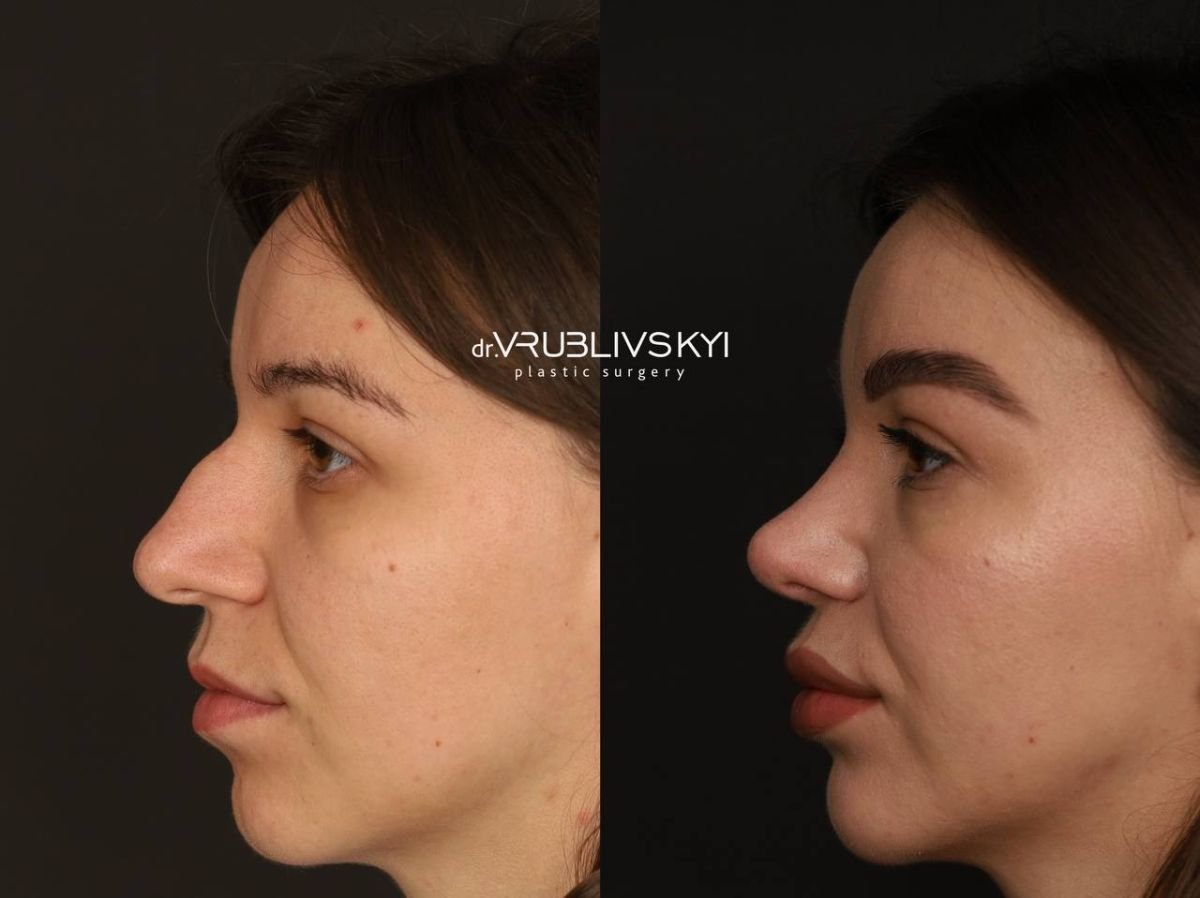 Before and after rhinoplasty results at Dr. VRUBLIVSKYI Plastic Surgery, nose reshaping