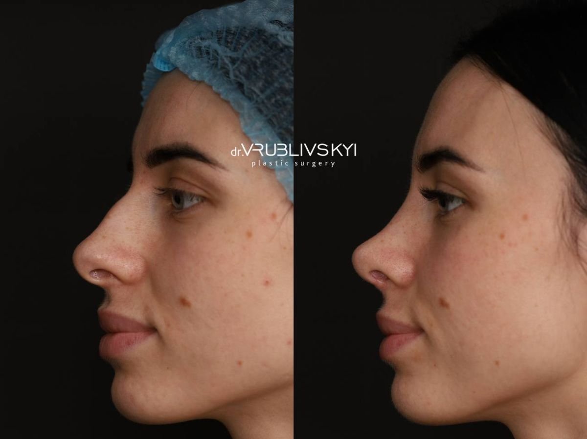 Before and after rhinoplasty results at Dr. VRUBLIVSKYI Plastic Surgery, nose reshaping
