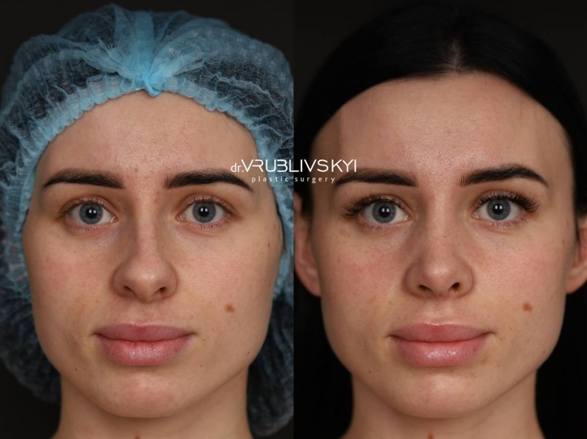 Before and after rhinoplasty results at Dr. VRUBLIVSKYI Plastic Surgery, nose reshaping