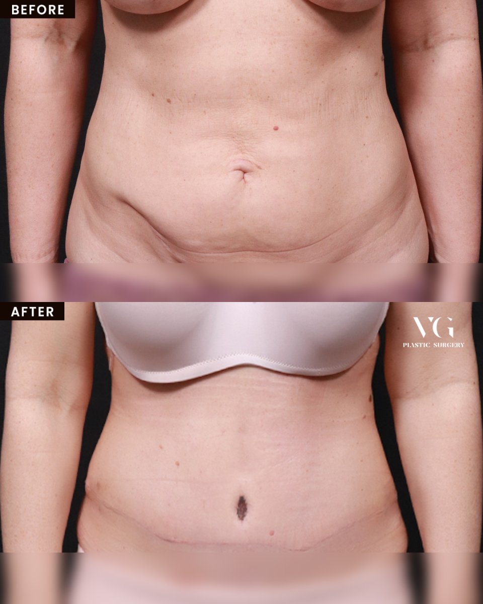 Before and after tummy tuck results at VG Plastic Surgery – improved abdominal contour