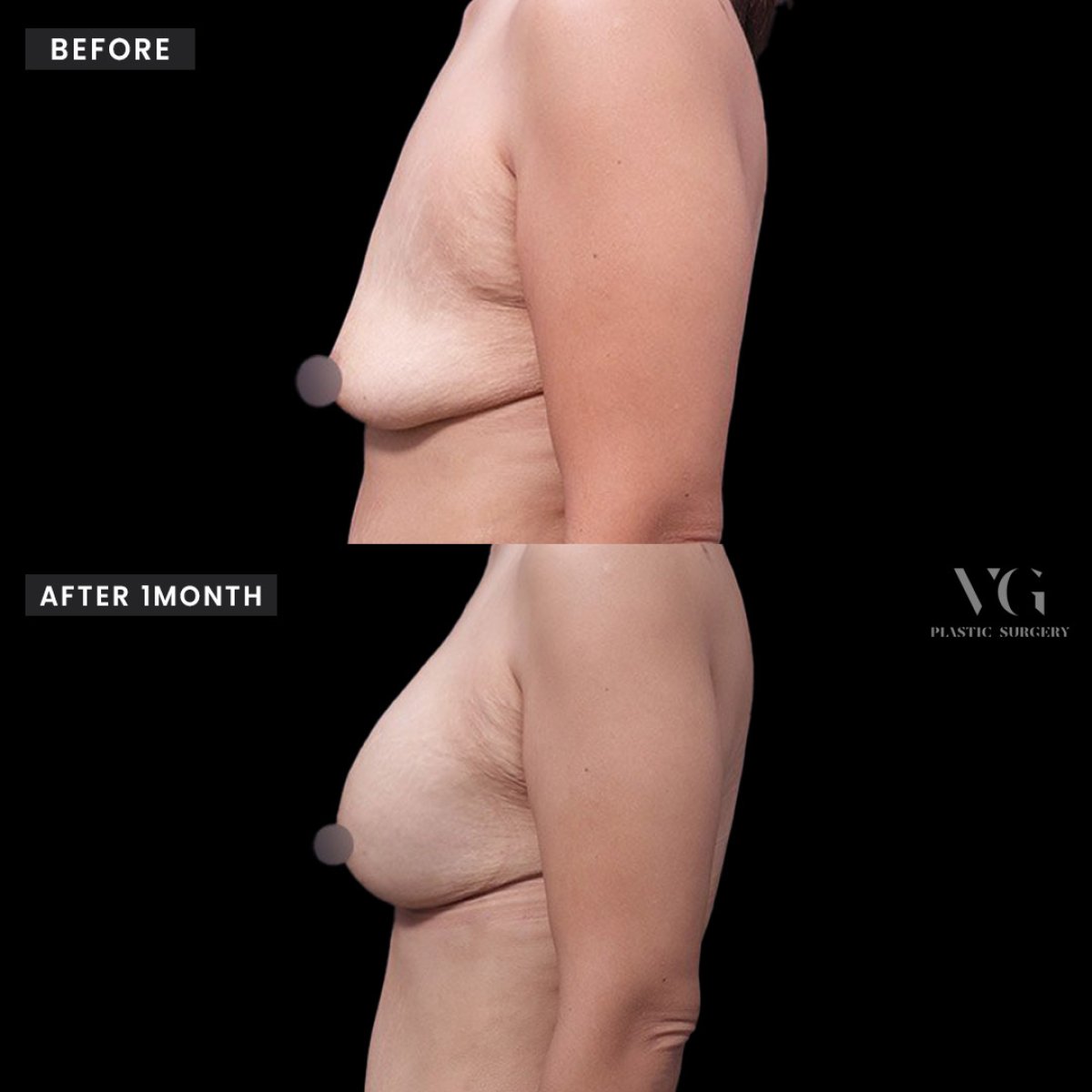 Antes y después de aumento de senos en VG Plastic Surgery, resultado de mayor volumen visible