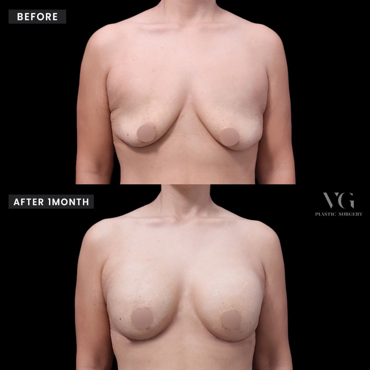 Resultados de aumento de senos antes y después en VG Plastic Surgery, mejora visible tras 1 mes
