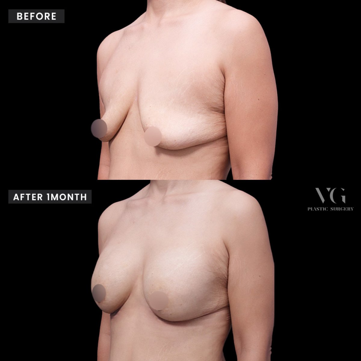نتائج قبل وبعد تكبير الثدي في VG Plastic Surgery، تحسين شكل الثدي
