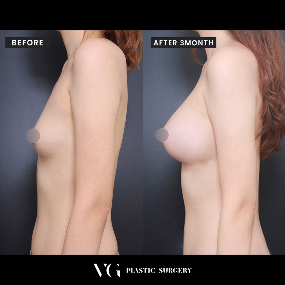 Before and after breast augmentation results at VG Plastic Surgery, enhanced breast volume