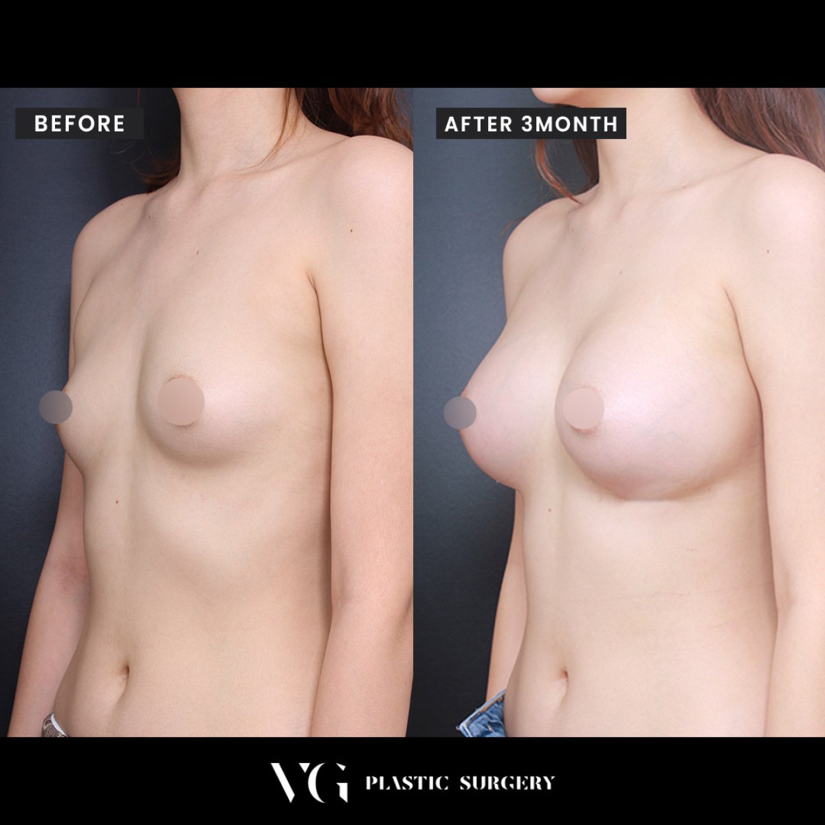 Resultados antes y después de aumento de senos en VG Plastic Surgery, mayor volumen mamario