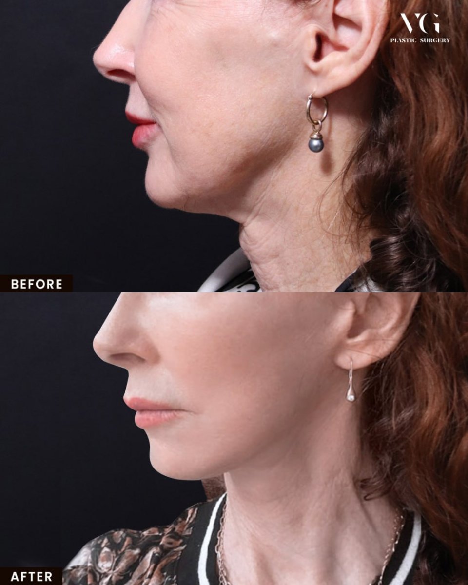 Resultados de lifting de cuello antes y después en VG Plastic Surgery, mejora del contorno