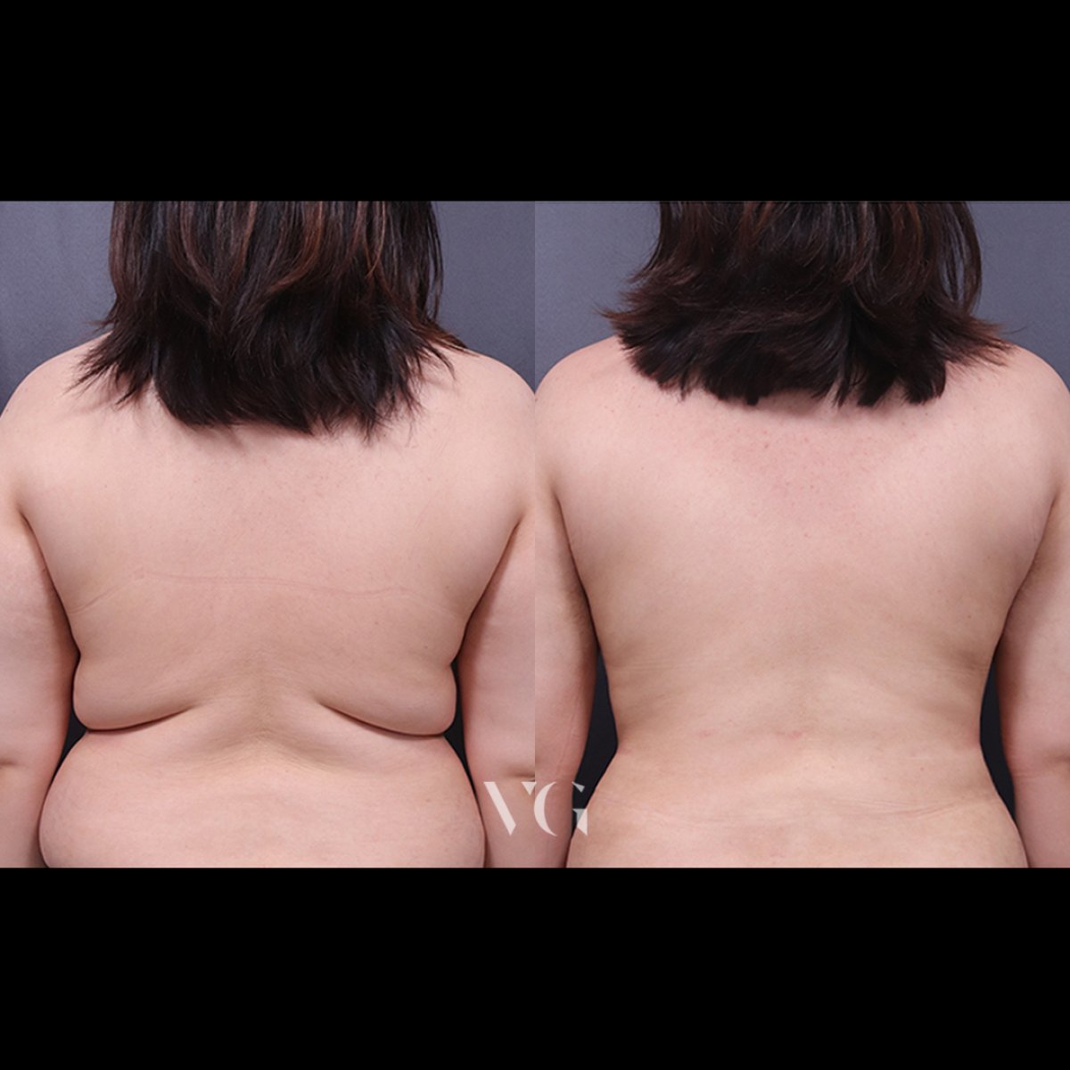 نتائج شفط دهون الظهر قبل وبعد في VG Plastic Surgery – تقليل واضح للدهون