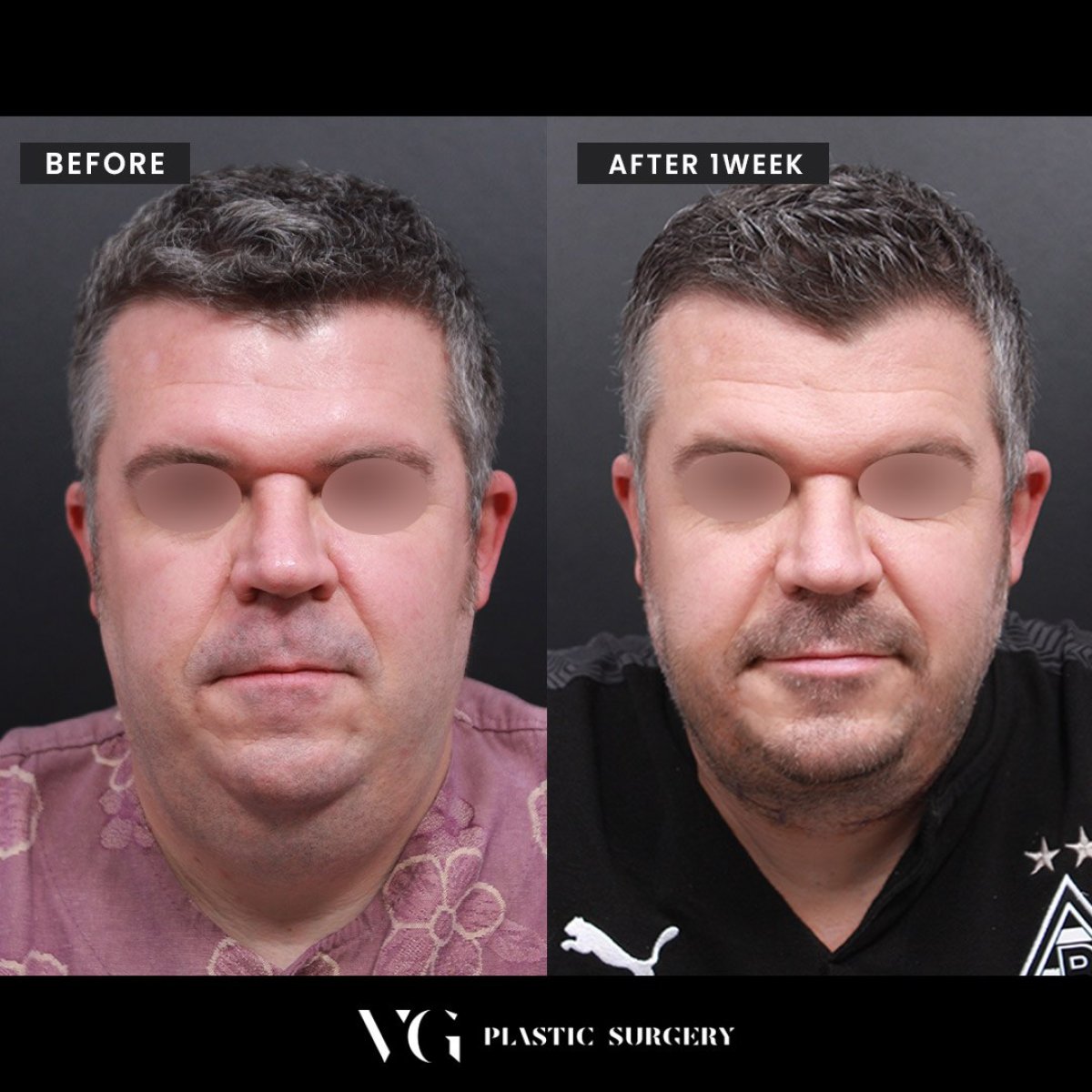 Resultados de liposucción de papada en VG Plastic Surgery, mejora visible de la mandíbula