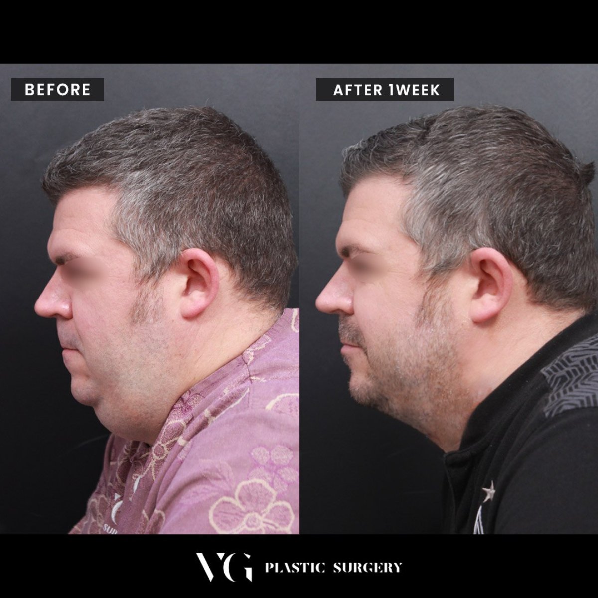 Antes y después de liposucción de papada en VG Plastic Surgery, mejora visible del mentón
