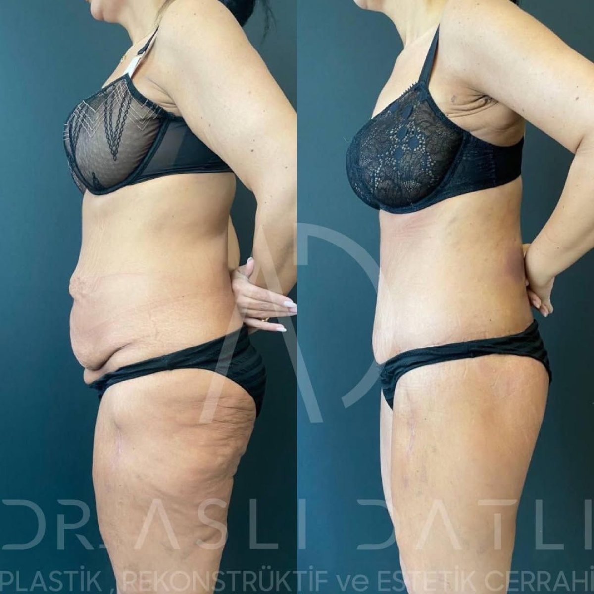Before and after 360 liposuction results at Liv Hospital Ulus, improved abdominal contour