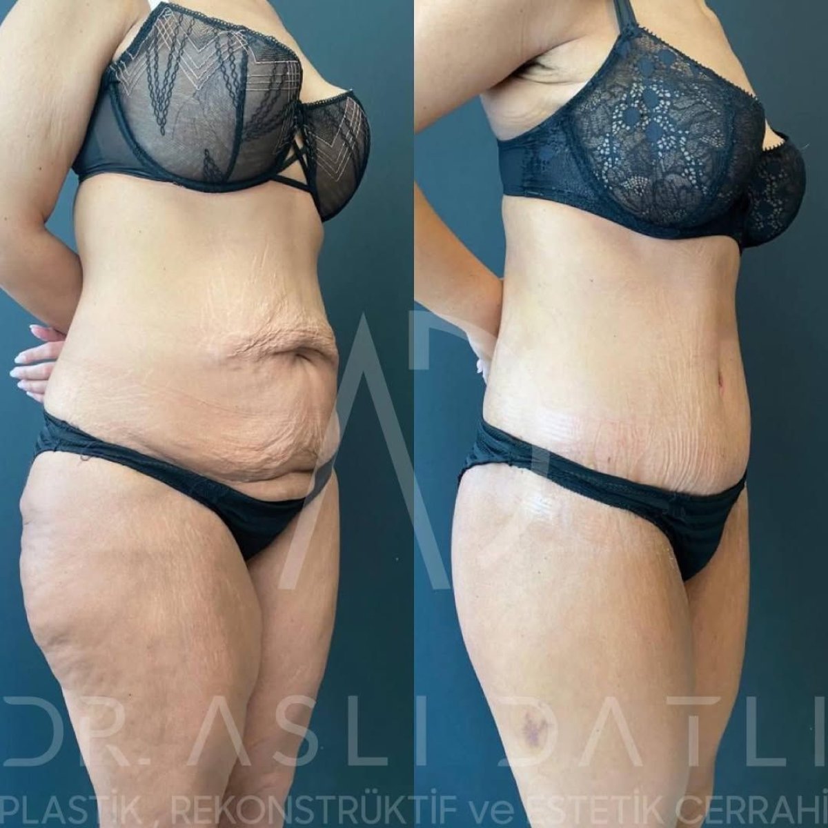 Before and after 360 liposuction results at Liv Hospital Ulus, improved abdominal contour
