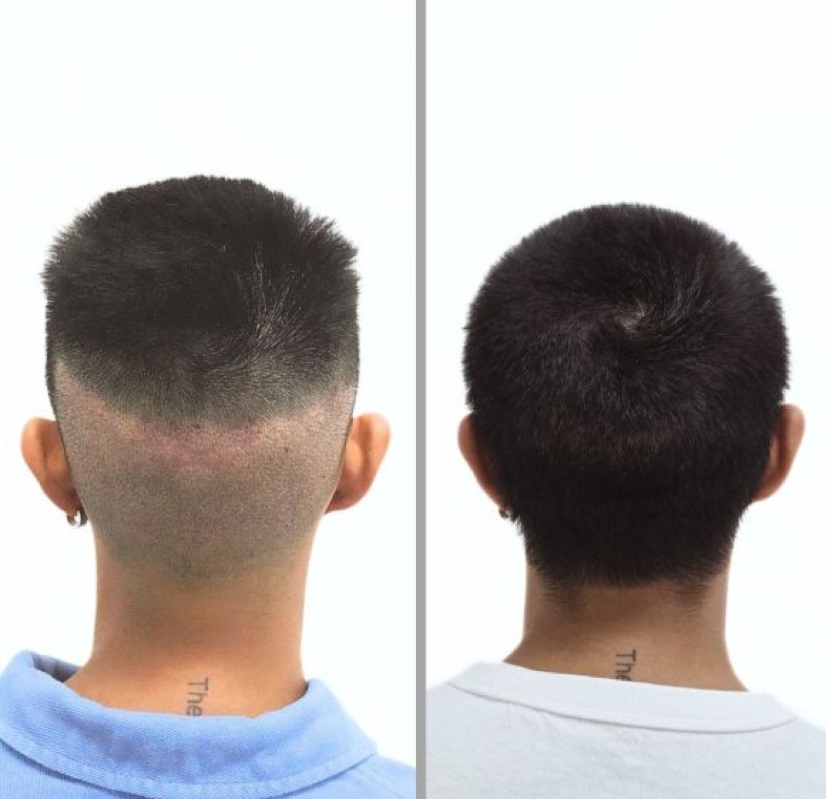Resultado de trasplante capilar antes y después en Dr.Nutt Clinic, mayor densidad capilar