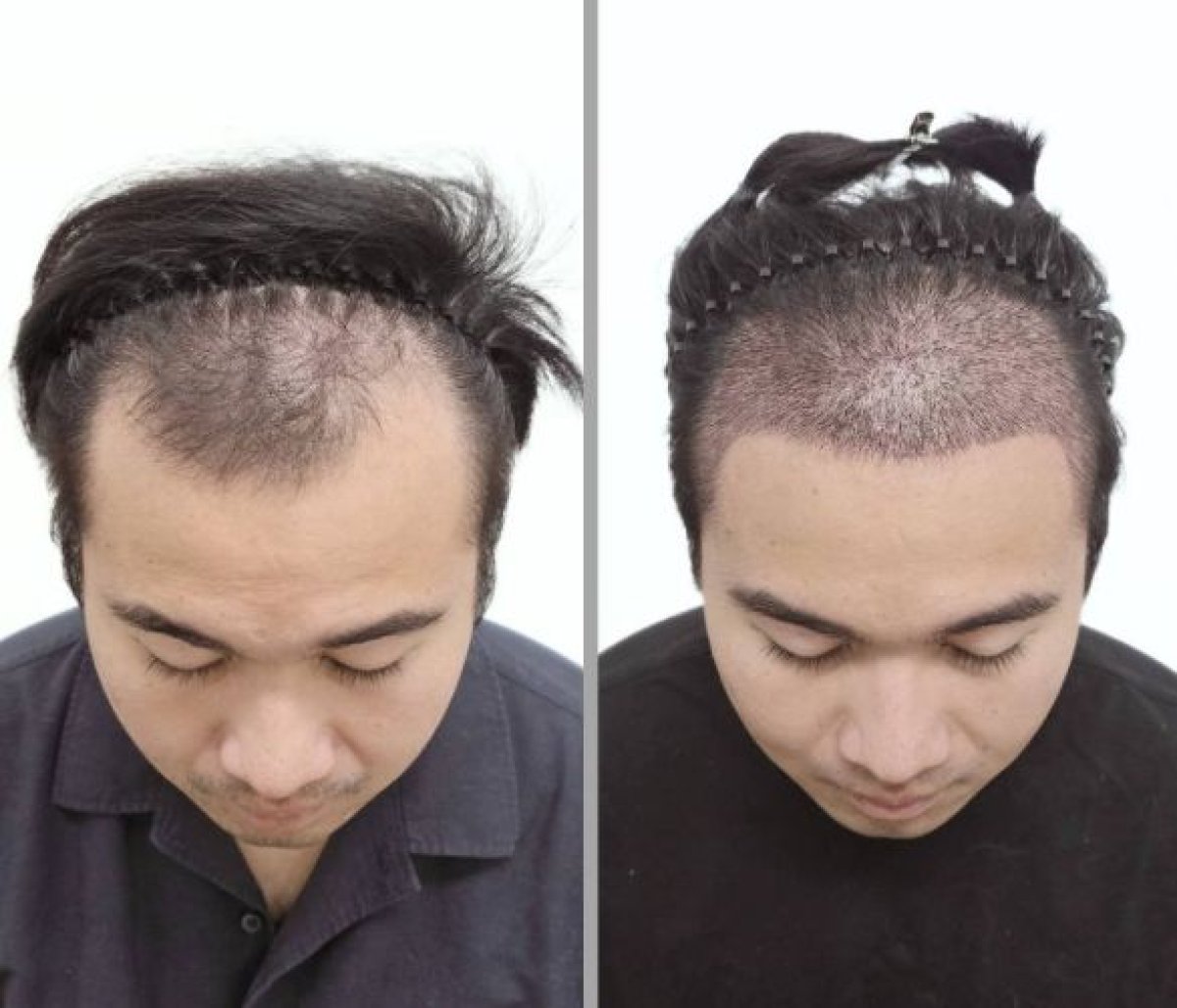 نتائج زراعة الشعر قبل وبعد في عيادة Dr.Nutt، كثافة شعر محسنة للرجال