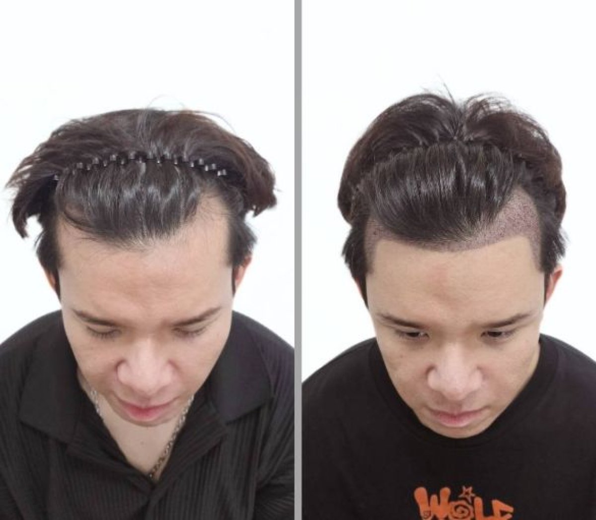 نتائج زراعة الشعر قبل وبعد في عيادة Dr.Nutt، استعادة خط الشعر