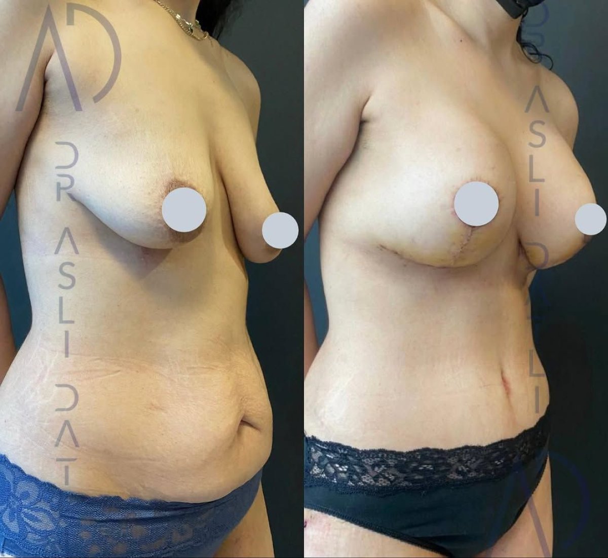 Before and after breast lift results at Liv Hospital Ulus, improved breast shape and contour