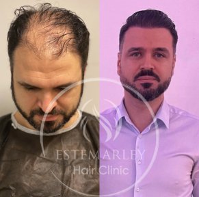 DHI Hair Transplant Premium Package - photo 6