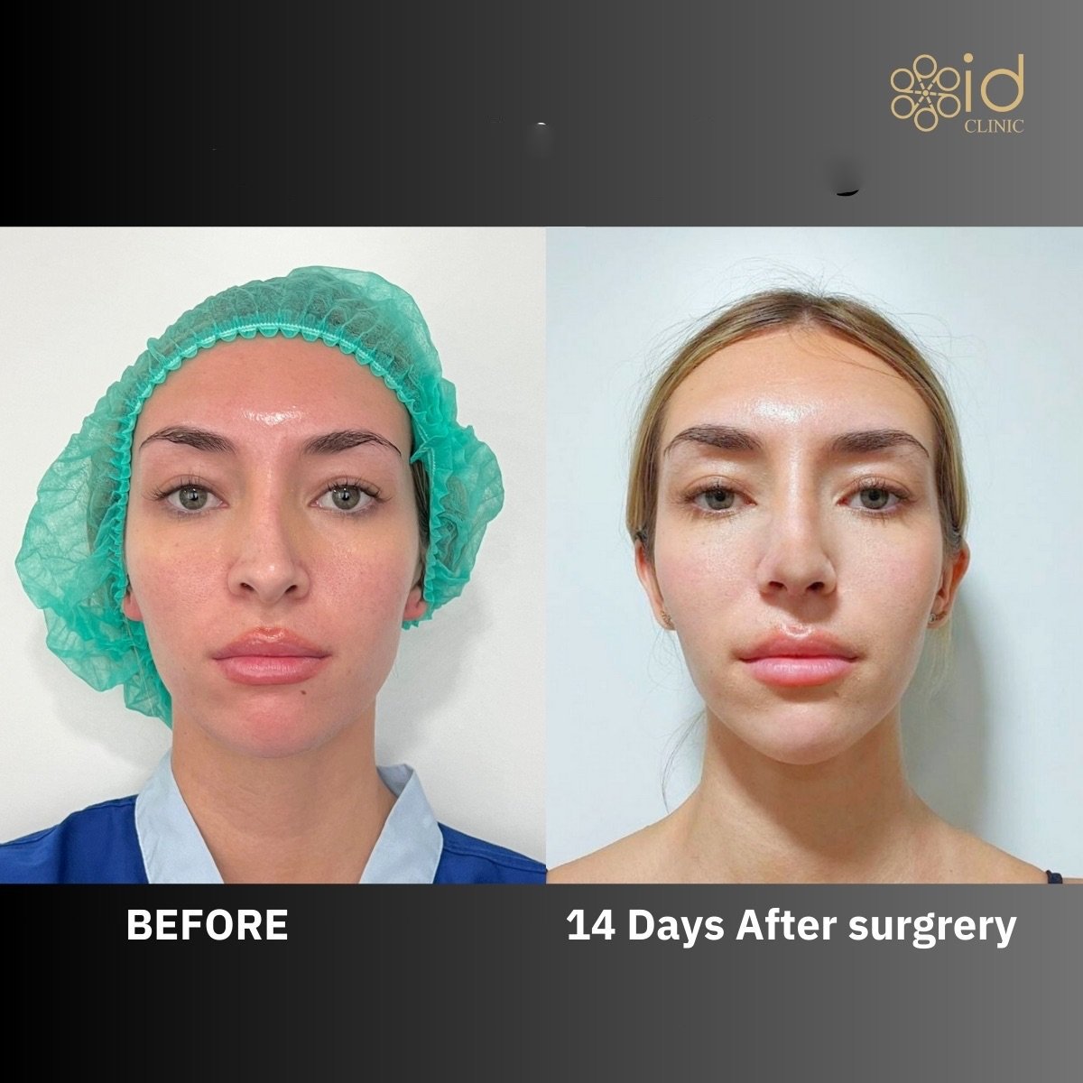 Before and after rhinoplasty result at ID Clinic Bangkok, 14 days post nose surgery