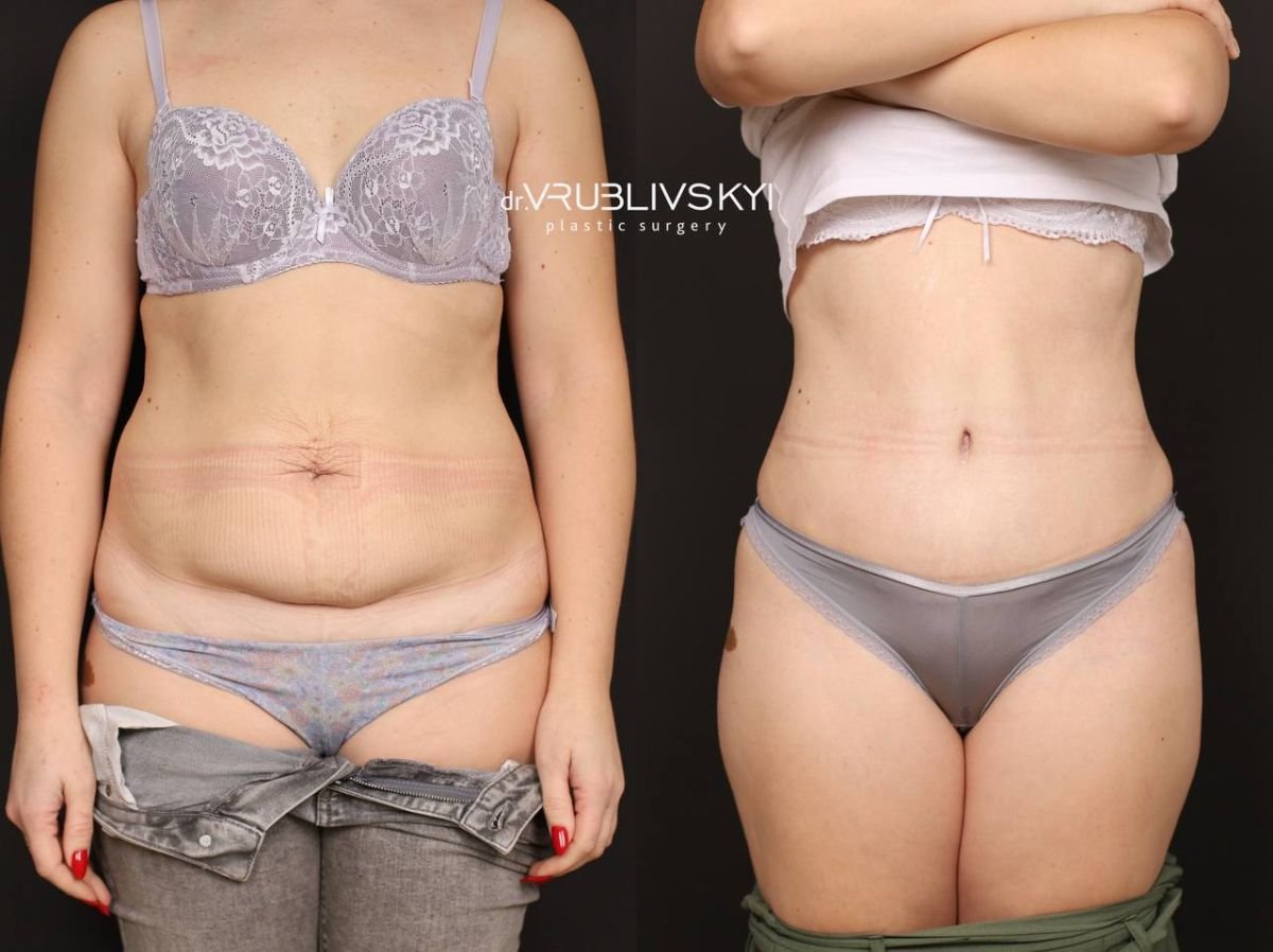 Результаты липосакции до и после в Dr. VRUBLIVSKYI Plastic Surgery, более стройный живот