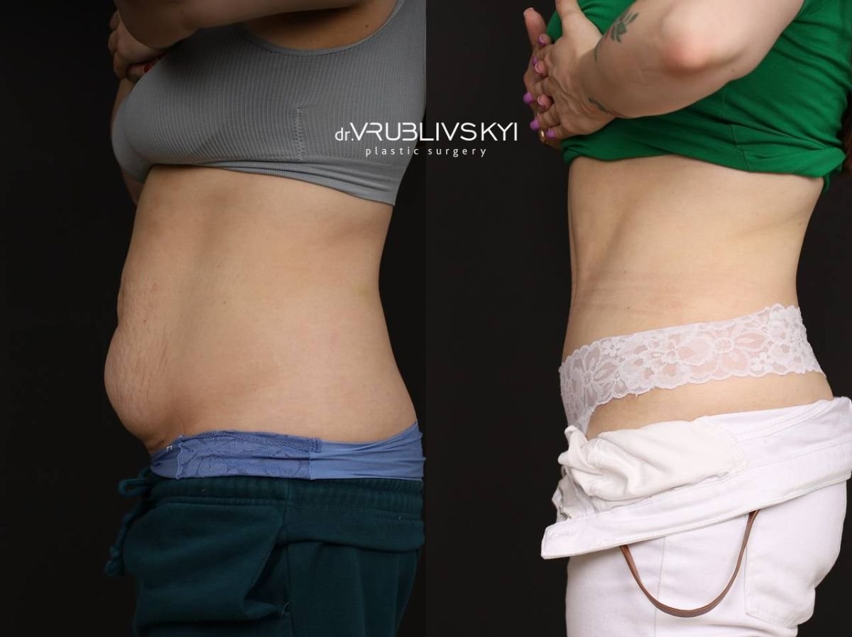 Resultados de liposucción antes y después en Dr. VRUBLIVSKYI Plastic Surgery, abdomen más delgado