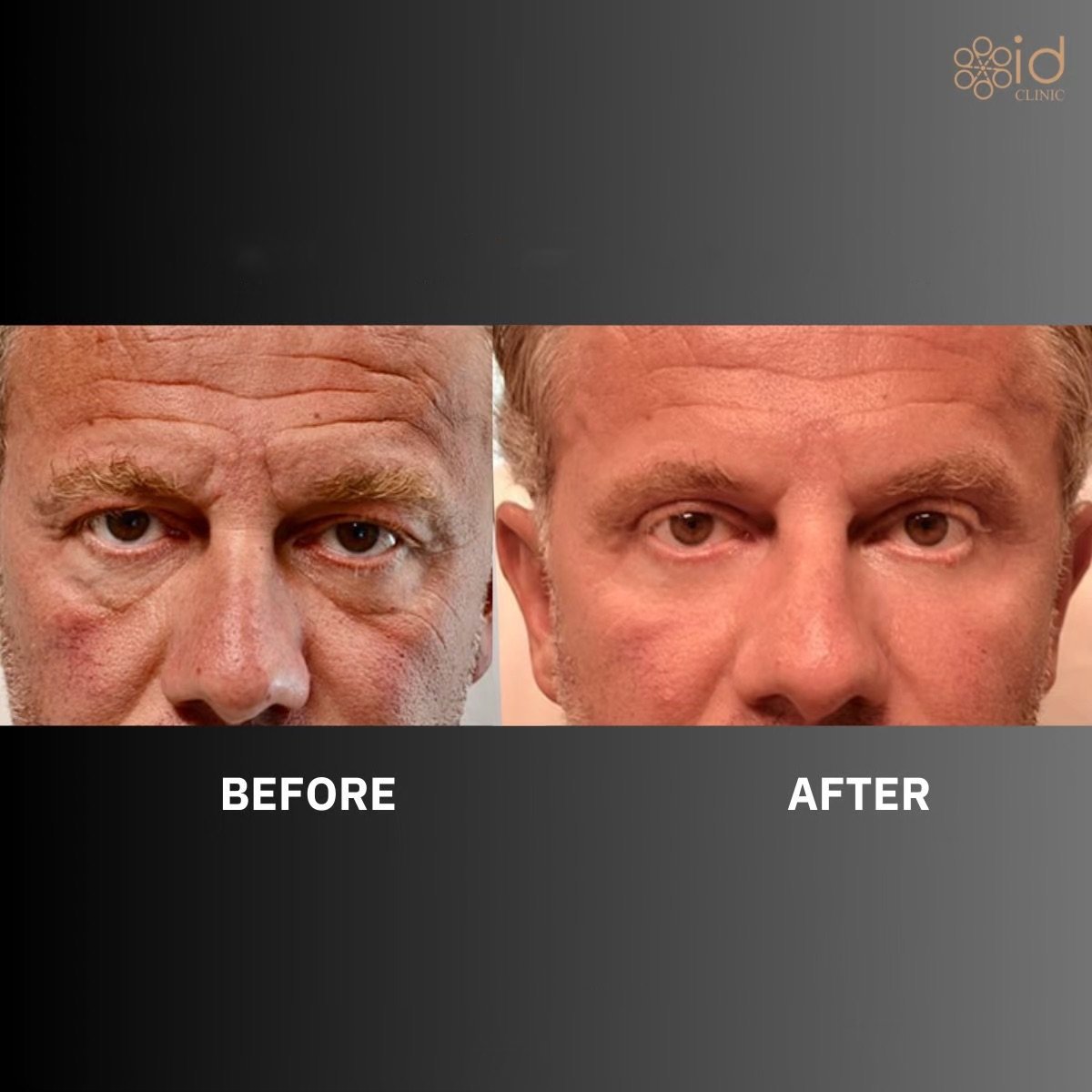 Before and after blepharoplasty results at ID Clinic Bangkok, eyelid correction for men