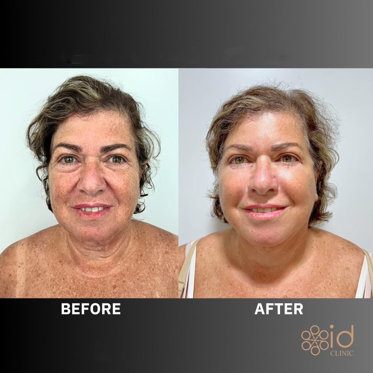 Before and after neck lift results at ID Clinic Bangkok, visible skin tightening and rejuvenation