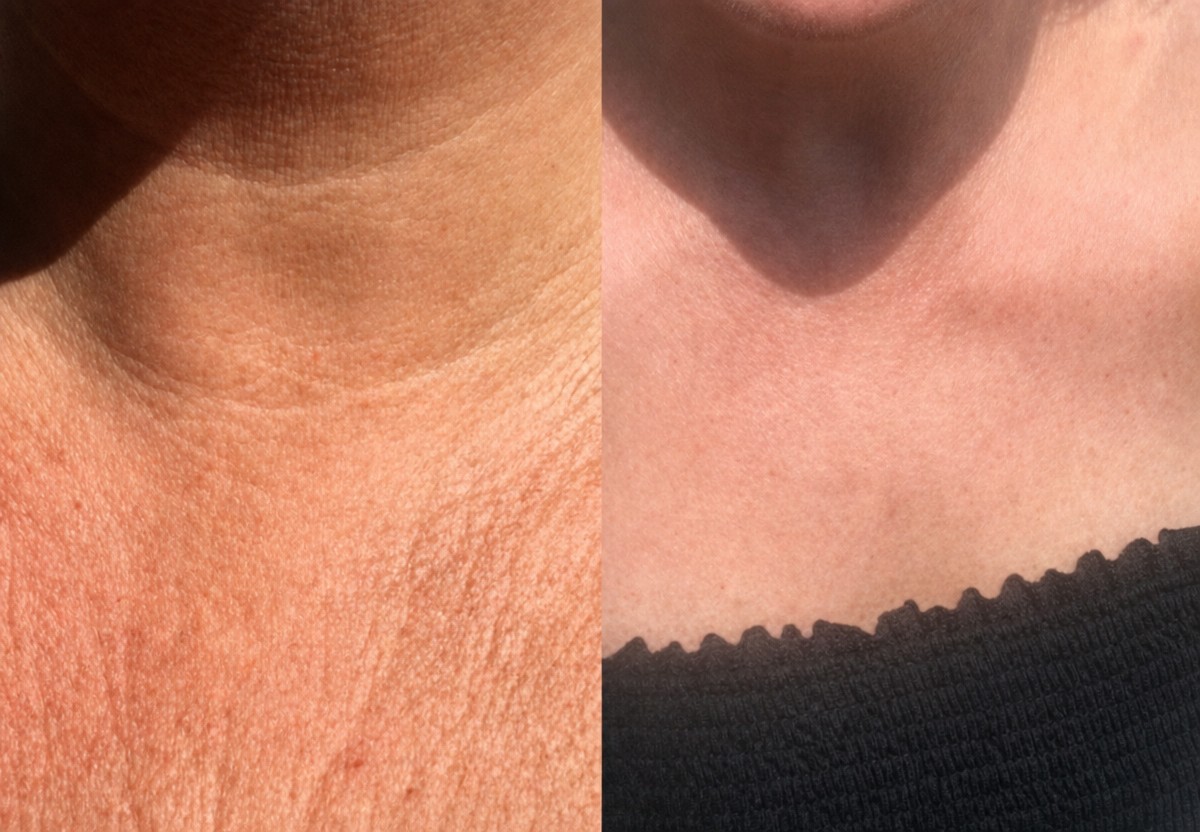 Resultados antes y después de rejuvenecimiento con células madre en cuello en LaCLINIQUE of Switzerland