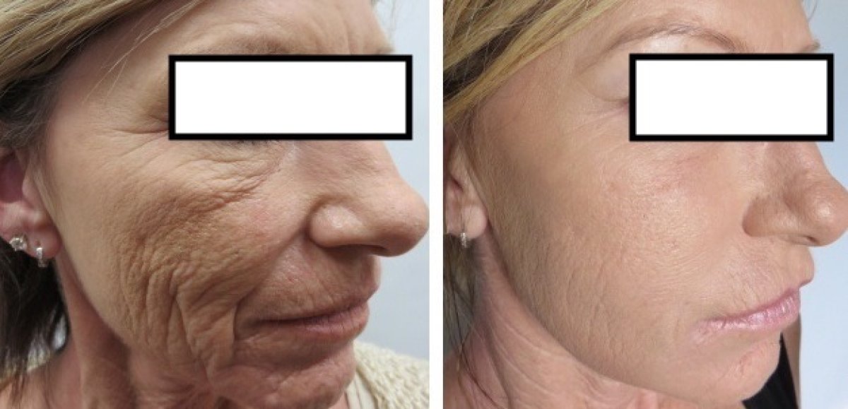 Before and after stem cell rejuvenation therapy result at LaCLINIQUE of Switzerland, anti-aging skin