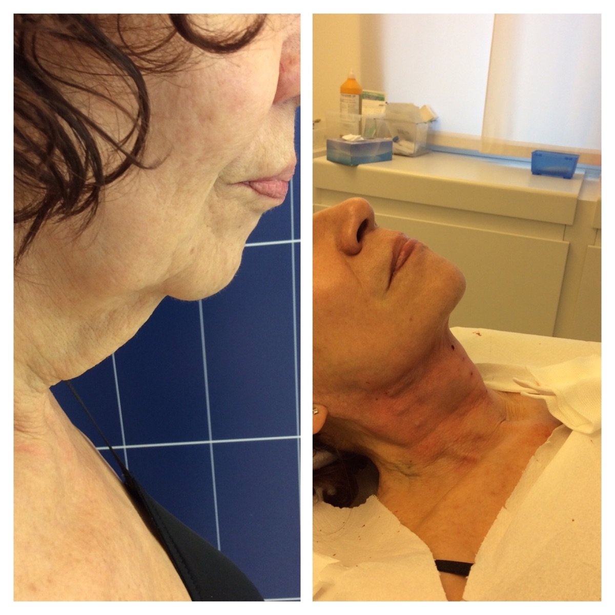 Antes y después de terapia de rejuvenecimiento con células madre en LaCLINIQUE of Switzerland, cuello firme