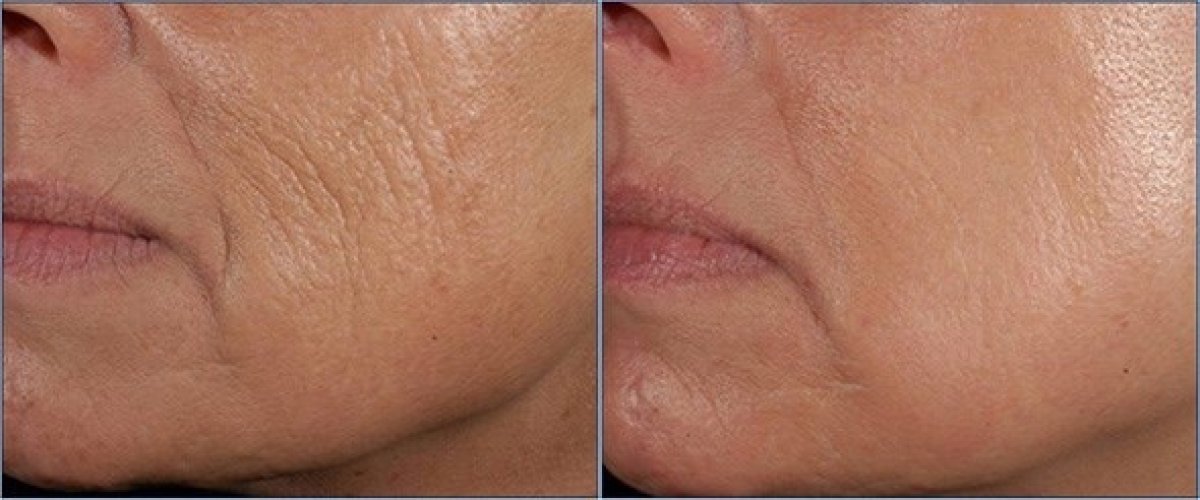 Before and after stem cell rejuvenation therapy at LaCLINIQUE of Switzerland, anti-aging result