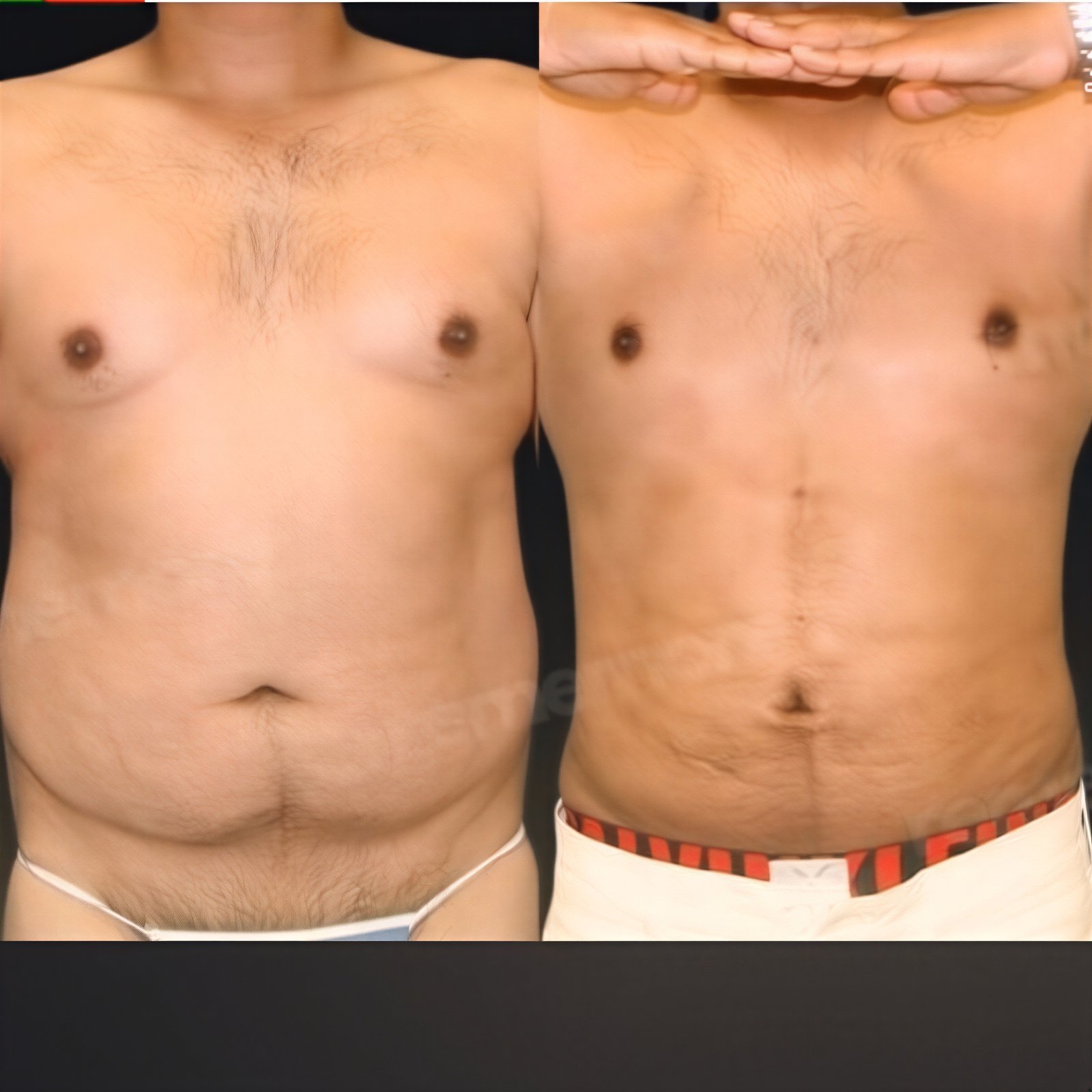 Resultados de liposucción antes y después en Memorial Bahçelievler Hospital, abdomen mejorado