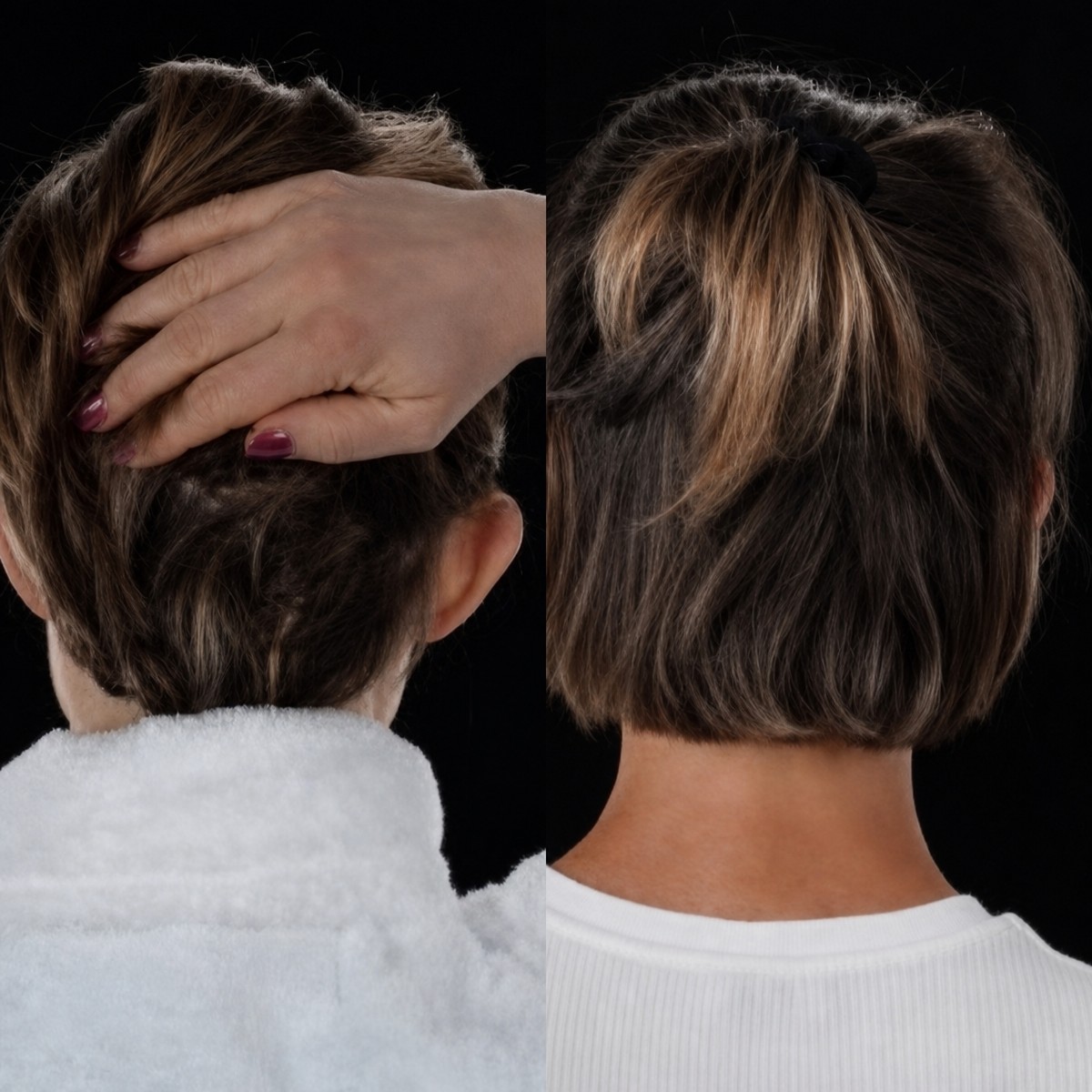 نتائج عملية تجميل الأذن قبل وبعد في Yurchenko Plastic Surgery Team Kyiv