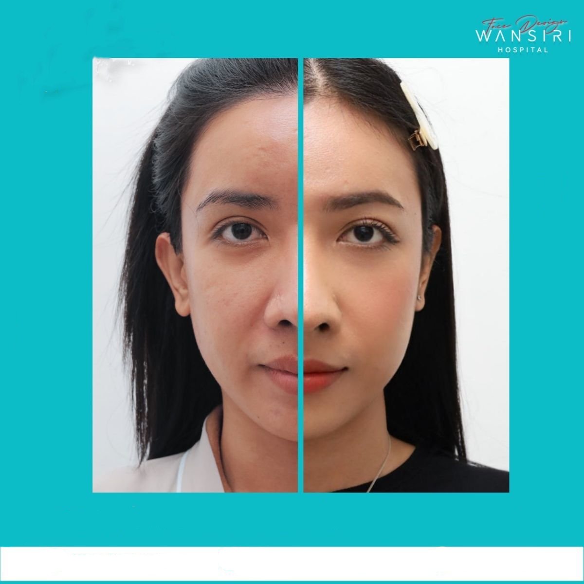 Resultados de cirugía de feminización facial antes y después en Wansiri Hospital, rasgos refinados