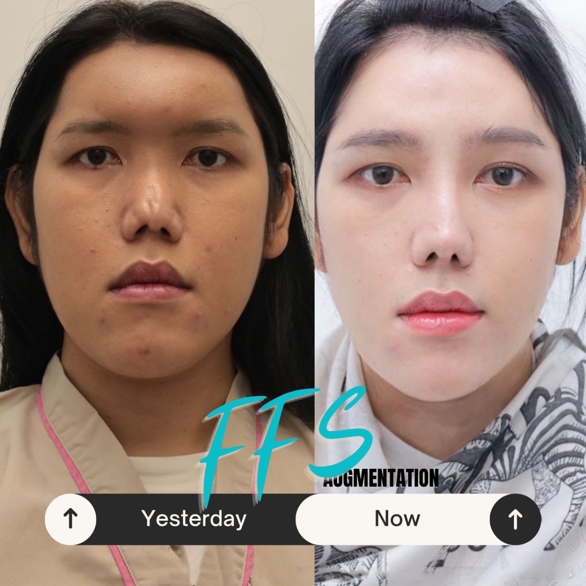 Resultados de cirugía de feminización facial antes y después en Wansiri Hospital, cambios visibles