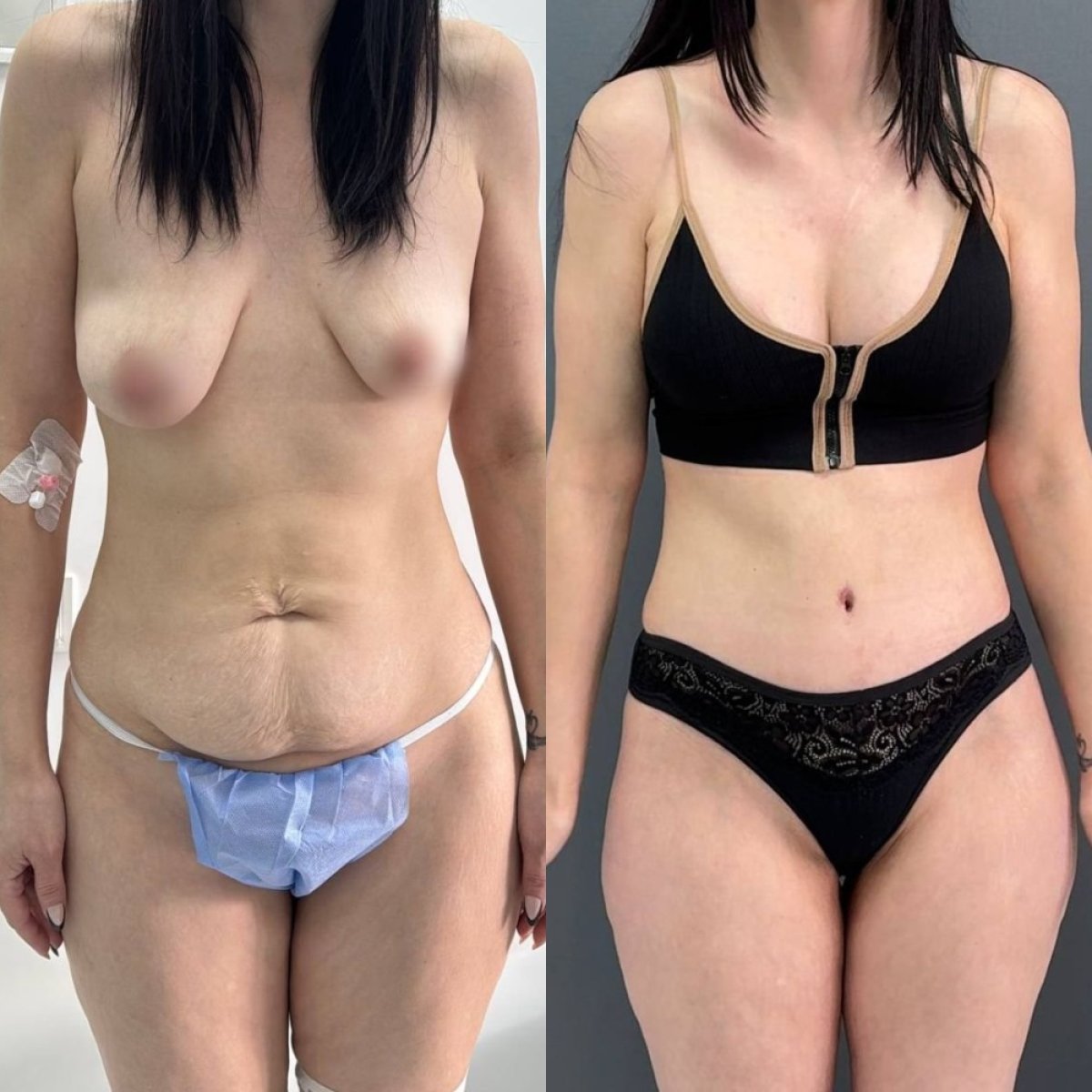 Resultados antes y después de lifting de senos en Dmytrii Homola Clinic, mejor contorno corporal