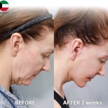 Fotos vor und nach Facelift durch Dr. Yong Woo Kim