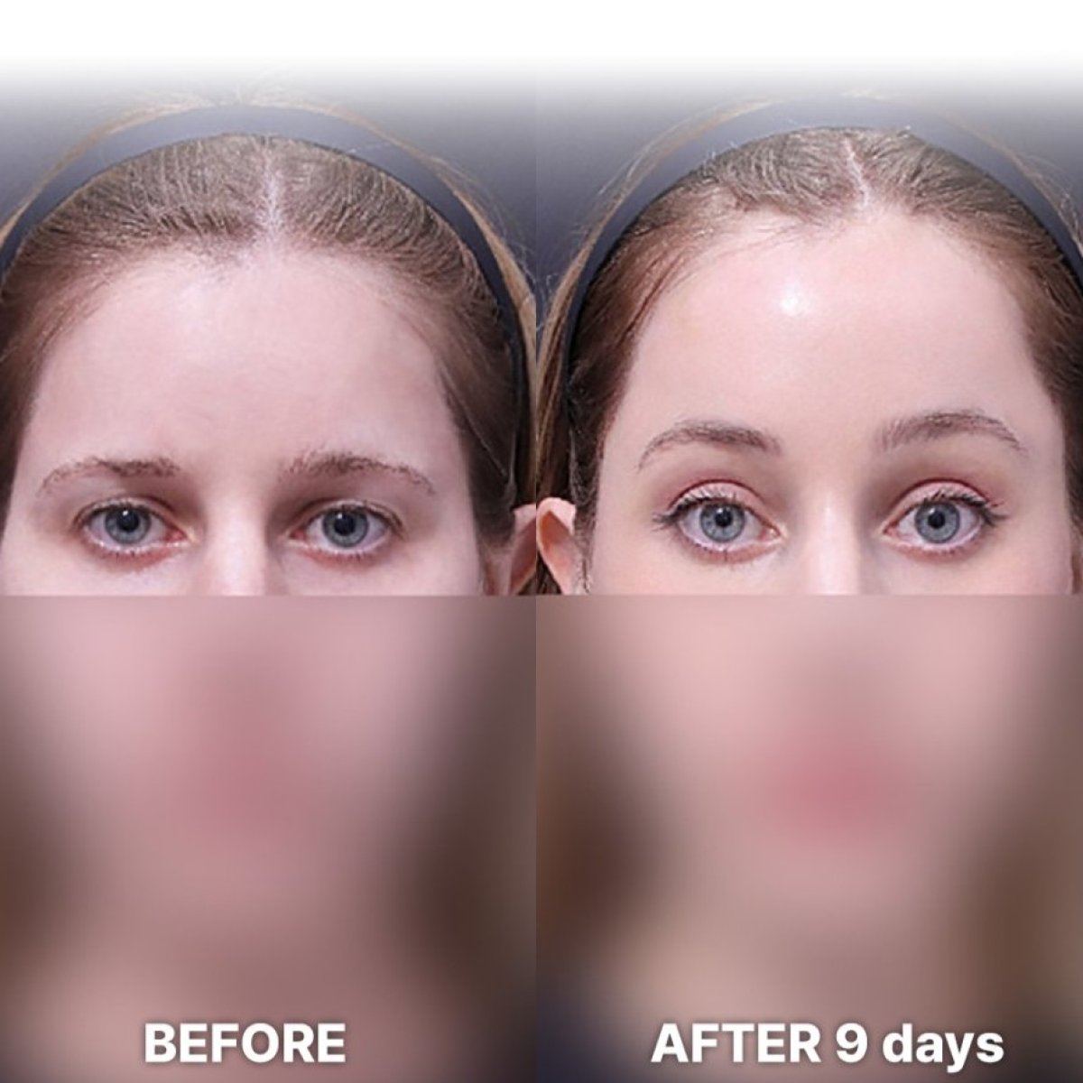 Forehead lift before and after results at Returning Plastic Surgery, visible brow elevation