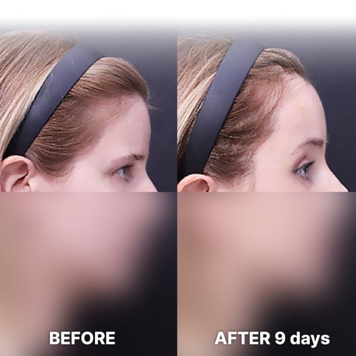 Forehead lift before and after 9 days result at Returning Plastic Surgery, visible brow elevation