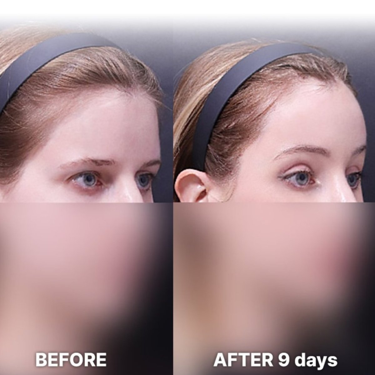 Forehead lift before and after results at Returning Plastic Surgery, visible brow elevation