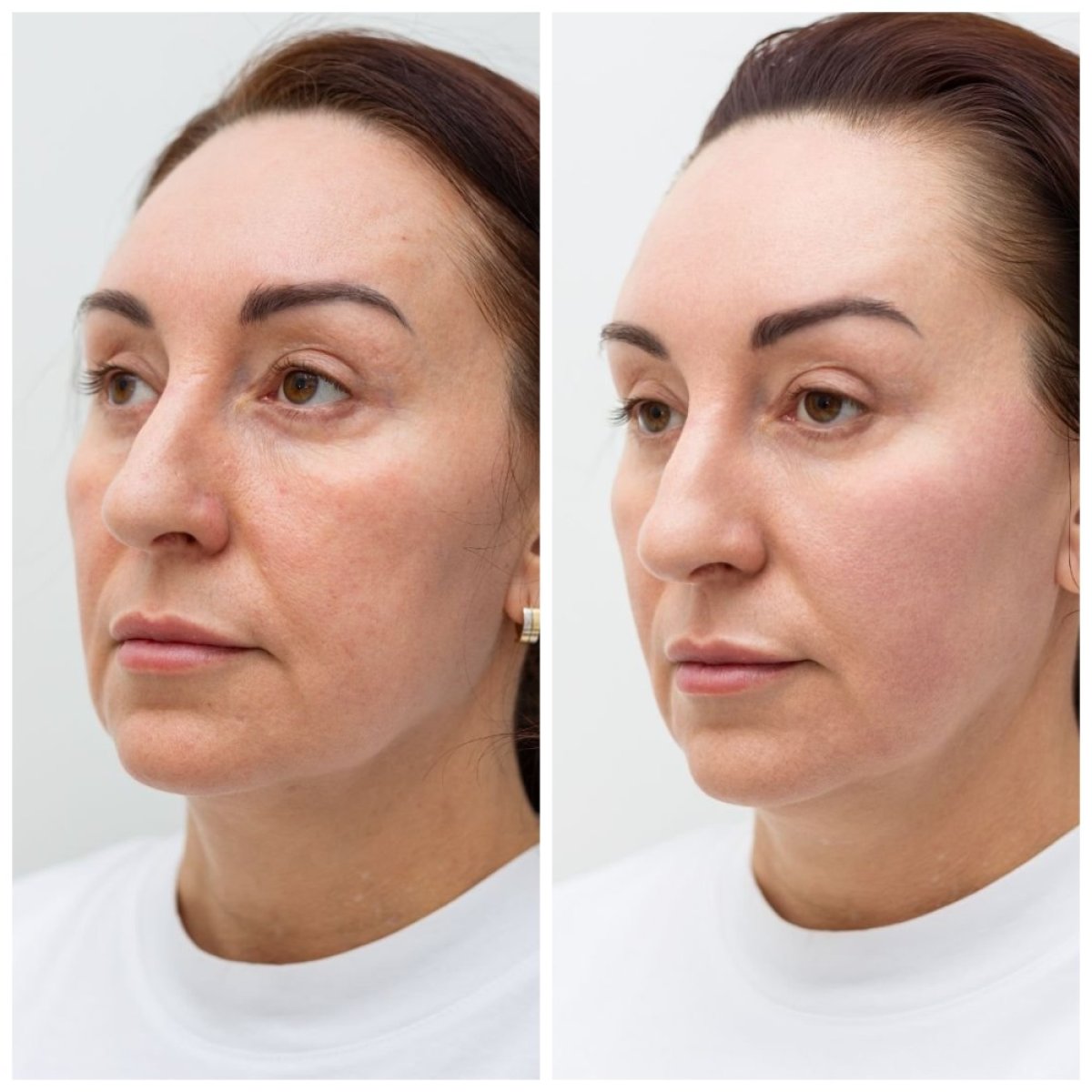 Facelift before and after results at Altos Clinic – visible facial rejuvenation and tightening