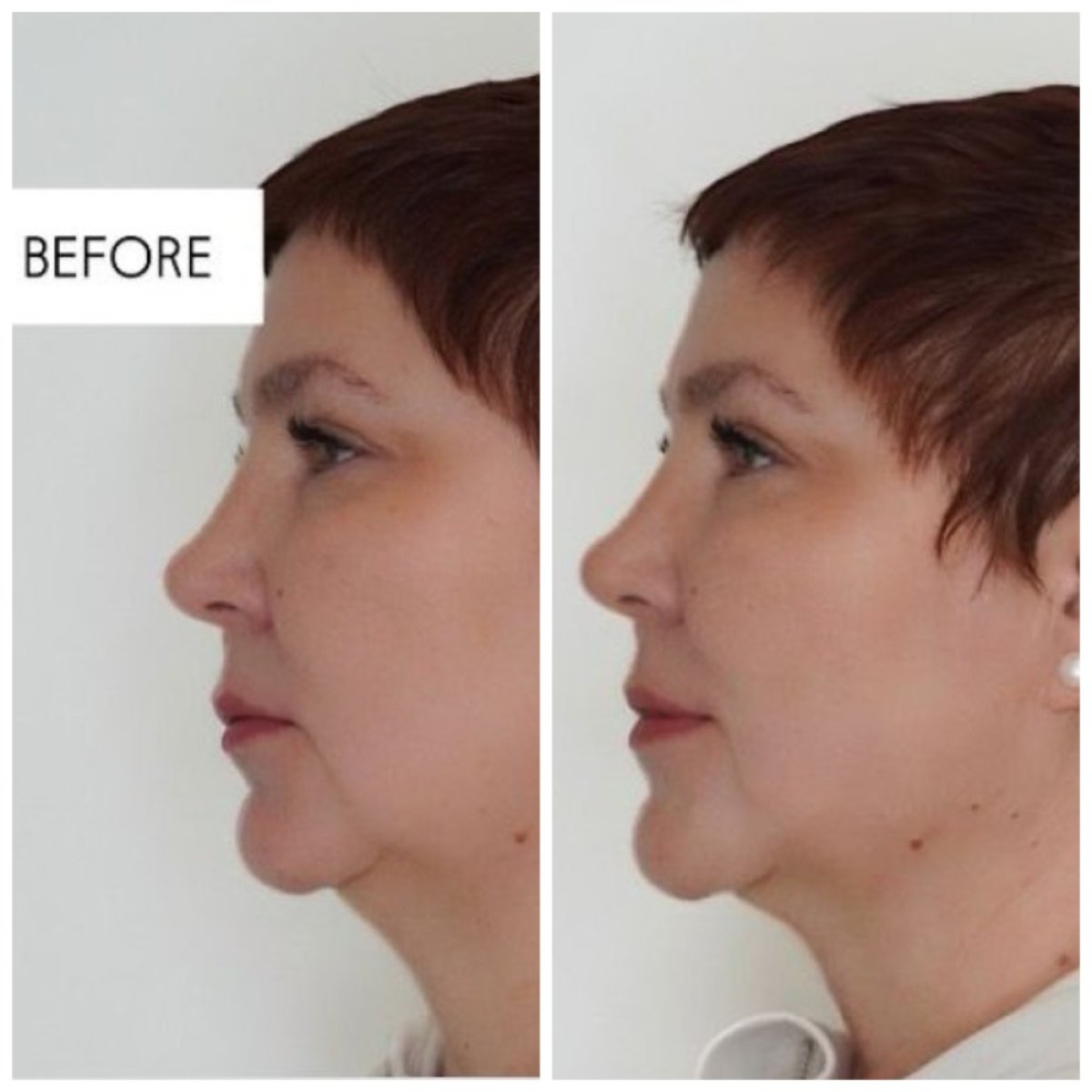Resultados antes y después de lifting facial sin cirugía en Altos Clinic, mejora del contorno facial