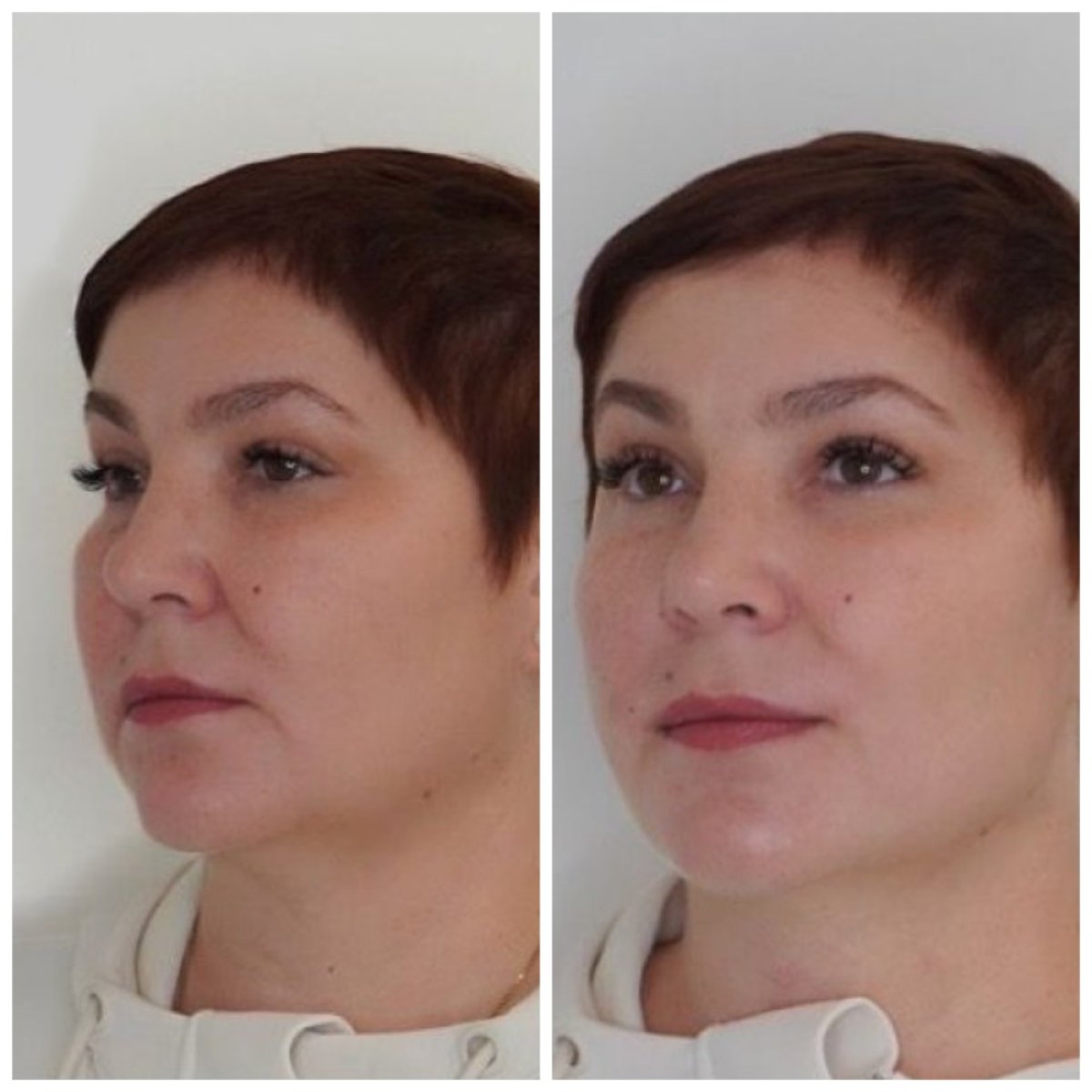 Resultados antes y después de lifting facial sin cirugía en Altos Clinic, mejora del contorno facial