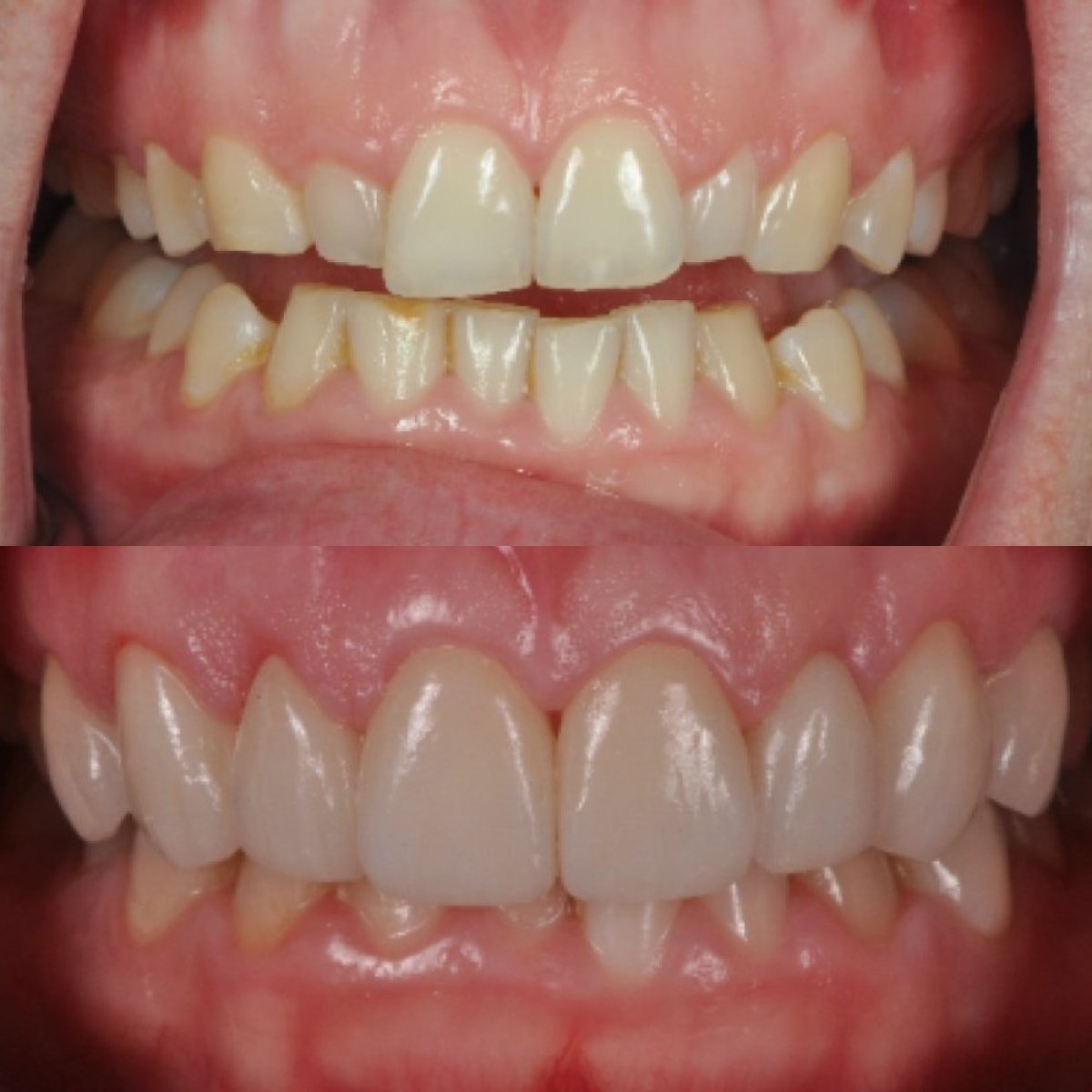 Résultats avant/après facettes en porcelaine à Kitcha Dental Clinic – transformation du sourire