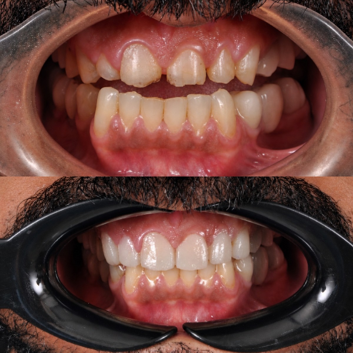 نتائج قبل وبعد تركيب تيجان الزركونيا في عيادة Kitcha Dental Clinic، تحسين الابتسامة