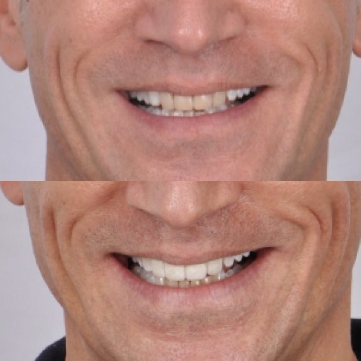 نتائج قبل وبعد تركيب تيجان الزركونيا في Kitcha Dental Clinic، ابتسامة محسنة